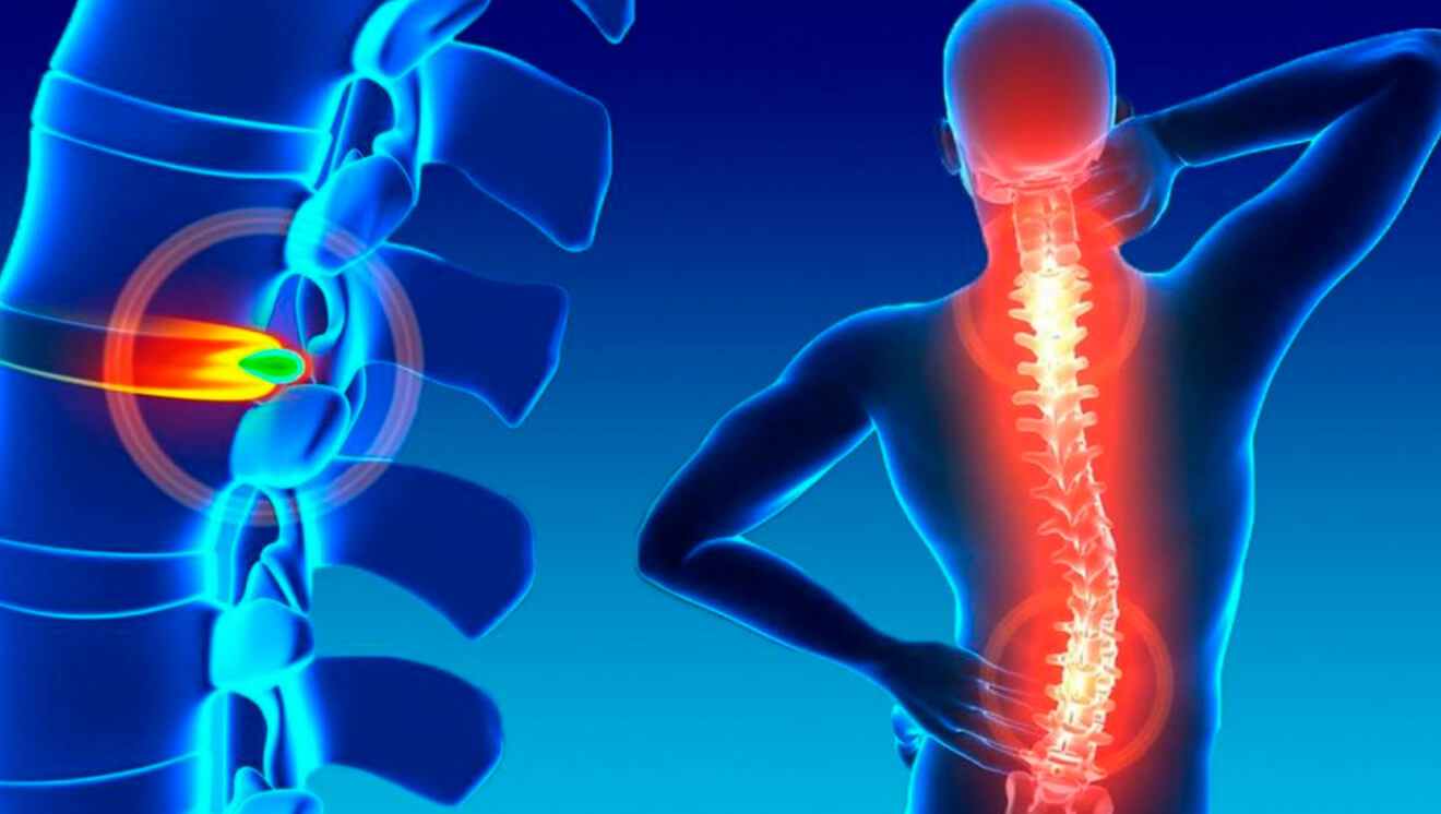Spinal Cord Stimulator South County, Back Pain